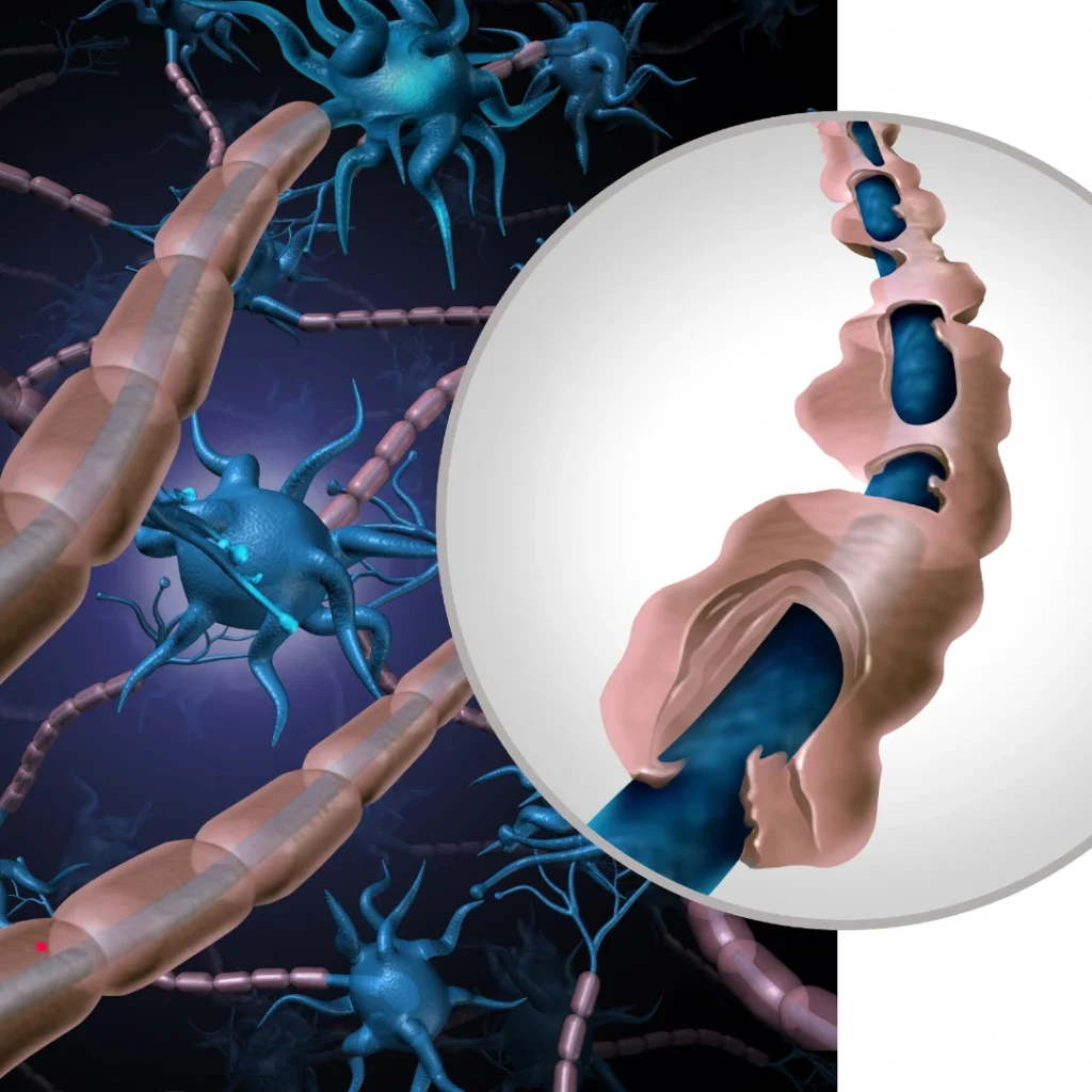 Multiple Sclerosis