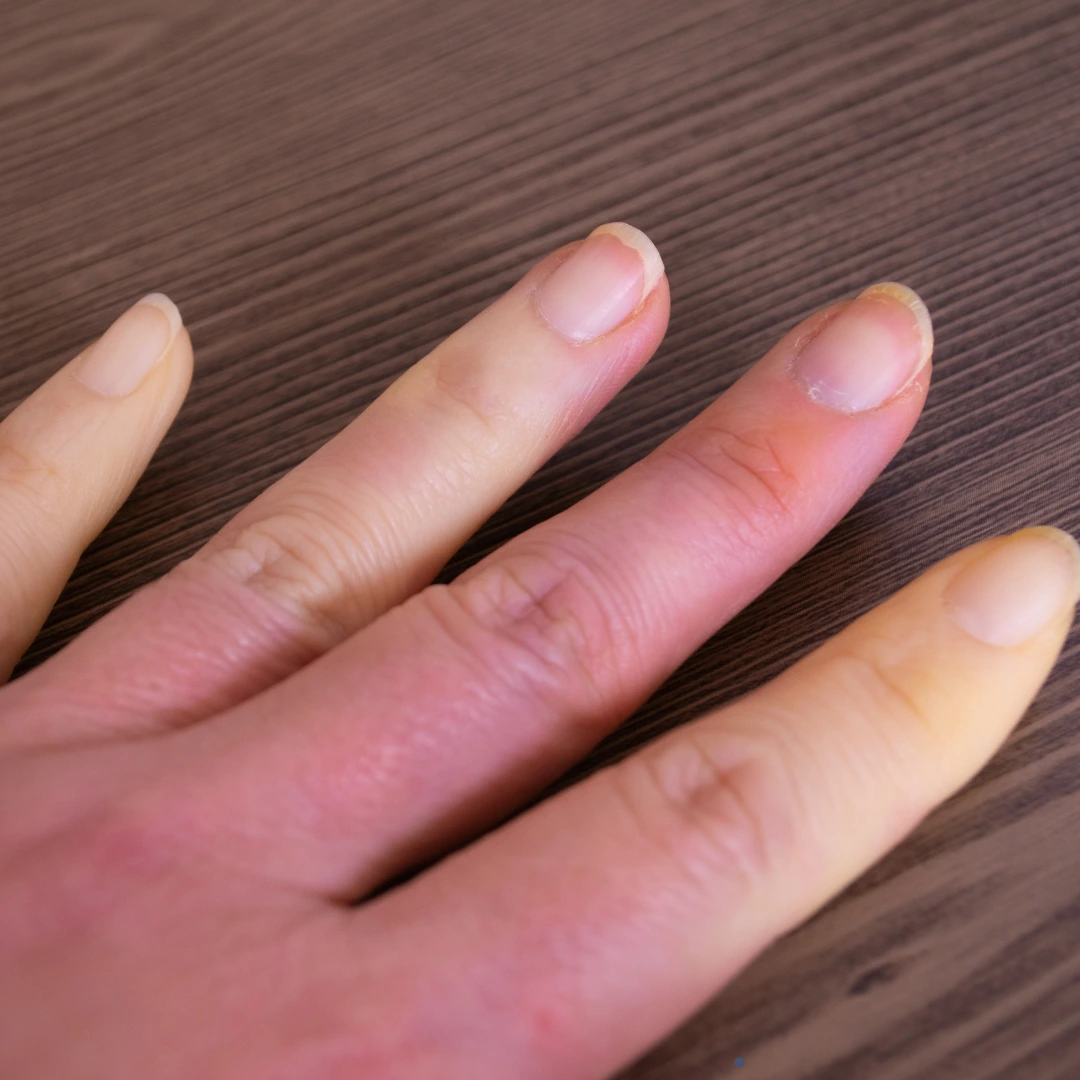 scleroderma