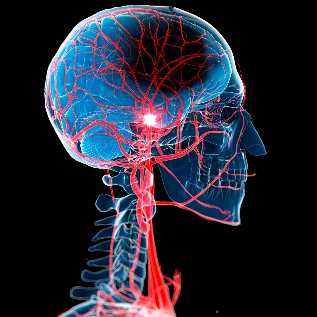 Stroke